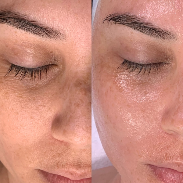 Vor Nach Hydrafacial SkinConcept Erding